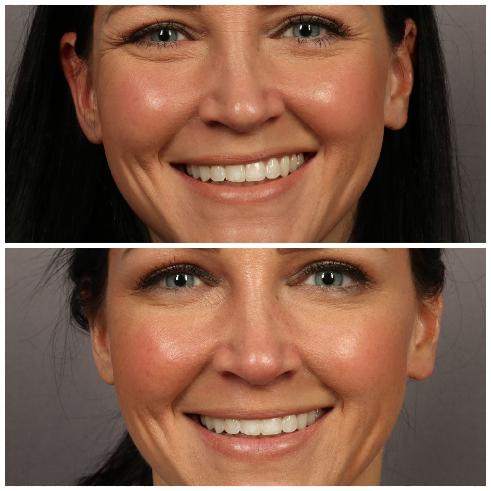 The Truth About Botox, Botox Before and After, MD Laser Studio Mooresville NC, Should I get Botox, Stilettos and Diapers, Molly Wey